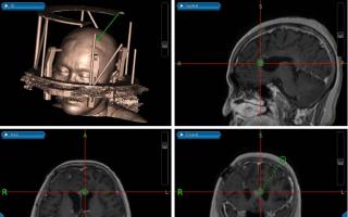 Limfom s primarnim oštećenjem mozga i leđne moždine